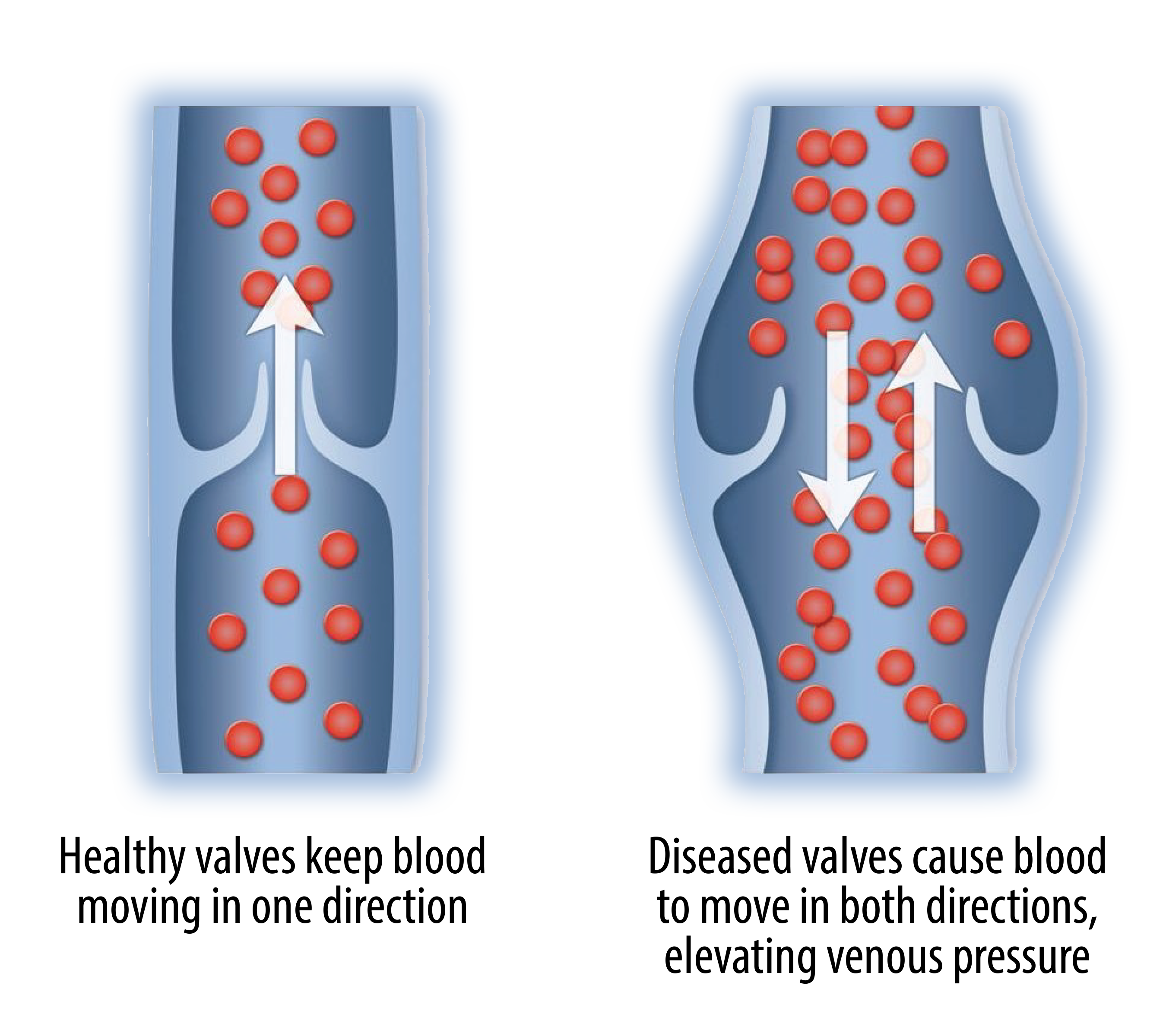An illustration of the difference between healthy and swollen veins that could be treated through vessel ablation or vein ablation.