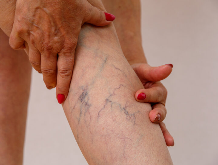 Elderly woman in white panties shows cellulite and varicose veins on a light isolated background, in need of a vein clinic.