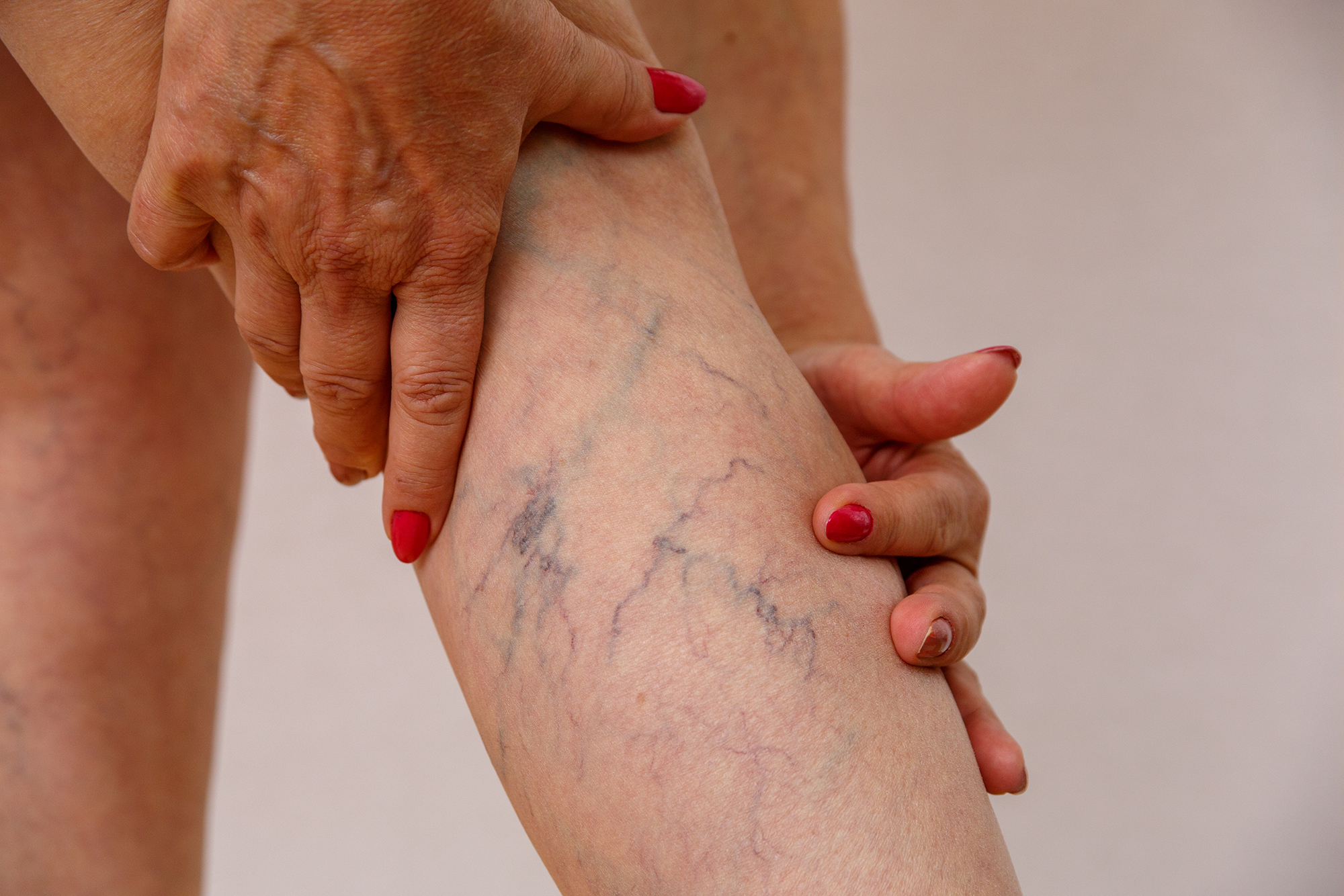 Elderly woman in white panties shows cellulite and varicose veins on a light isolated background, in need of a vein clinic.