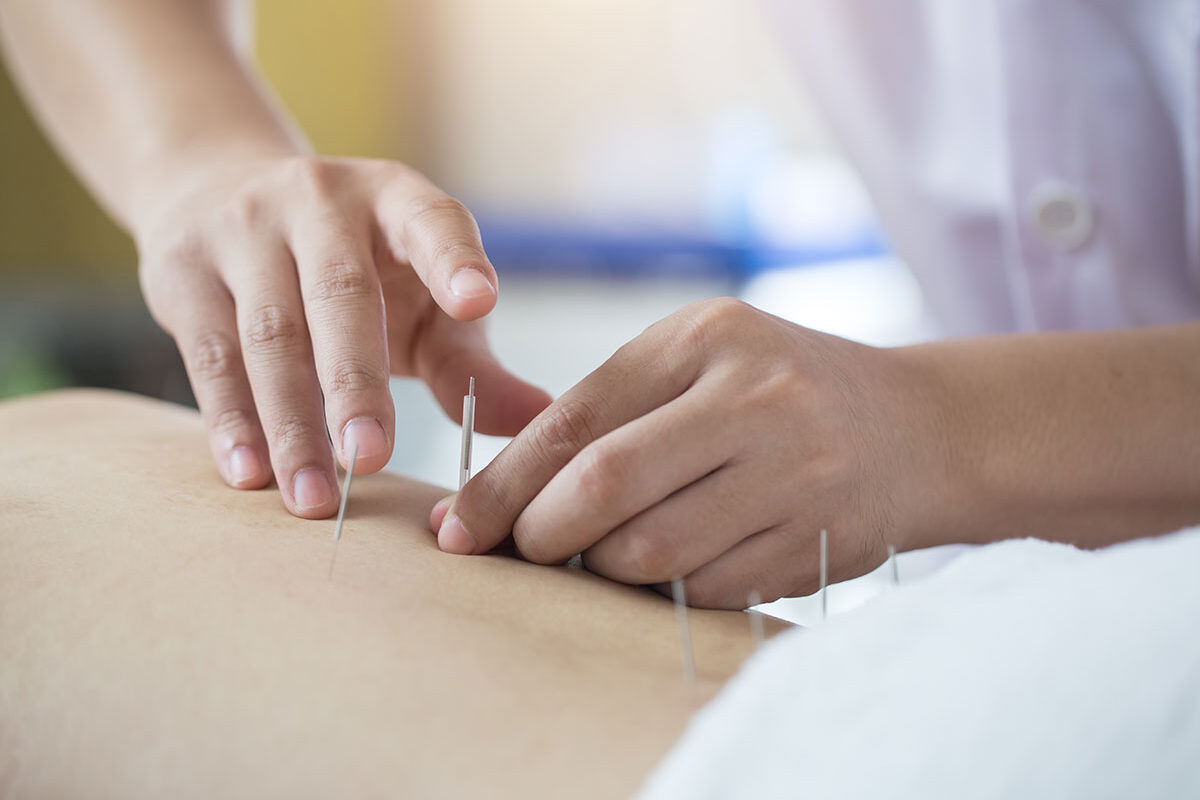 A close-up of acupuncture therapy performed on a patient's back as part of their acupuncture treatment plan.