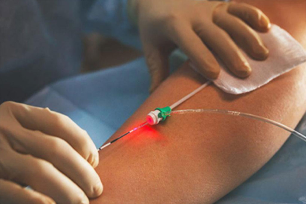 A doctor performing a vessel ablation on a patient's leg.