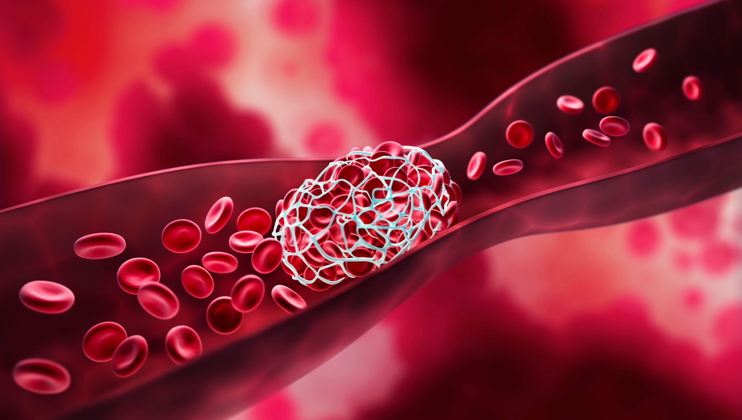 An illustrative depiction of a blood clot blocking a vein in swollen legs.
