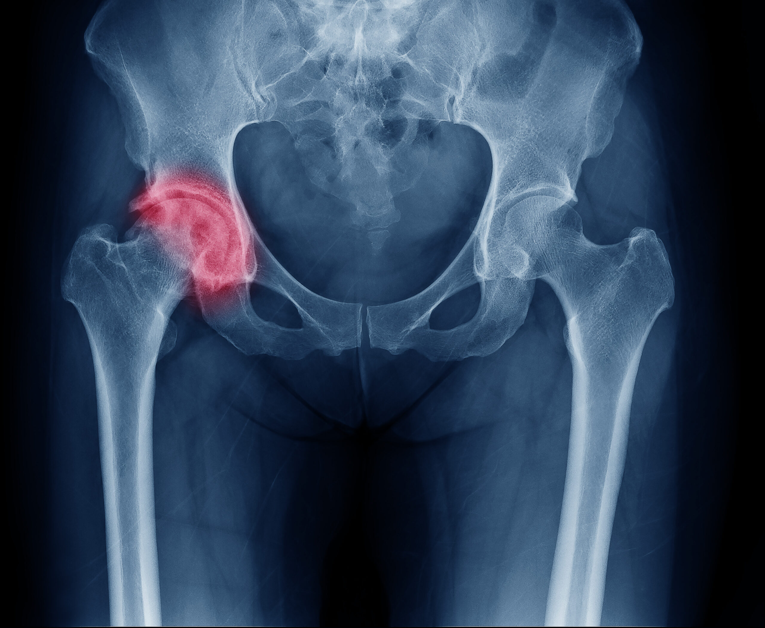 An X-ray view of a hip joint causing hip and leg pain.
