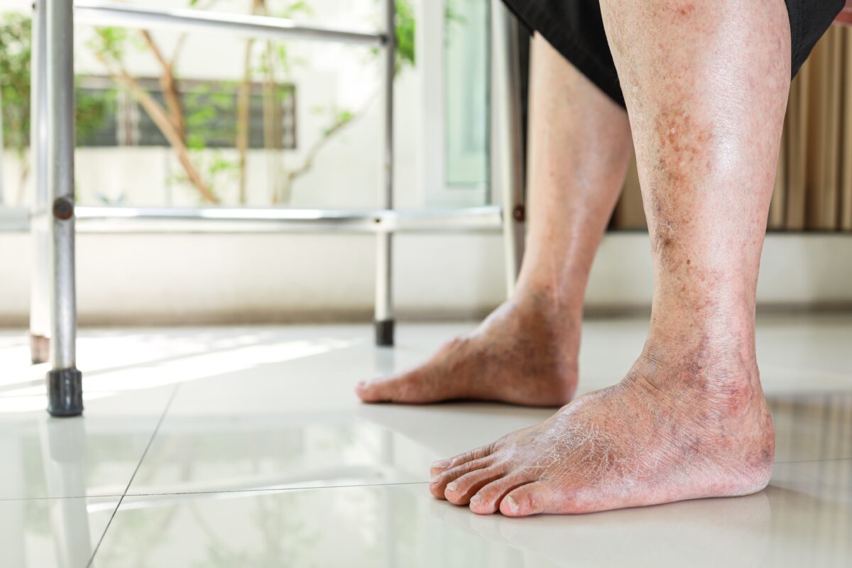 Poor circulation to feet causing an elderly man's bare feet to be bruised, mottled, and swollen.