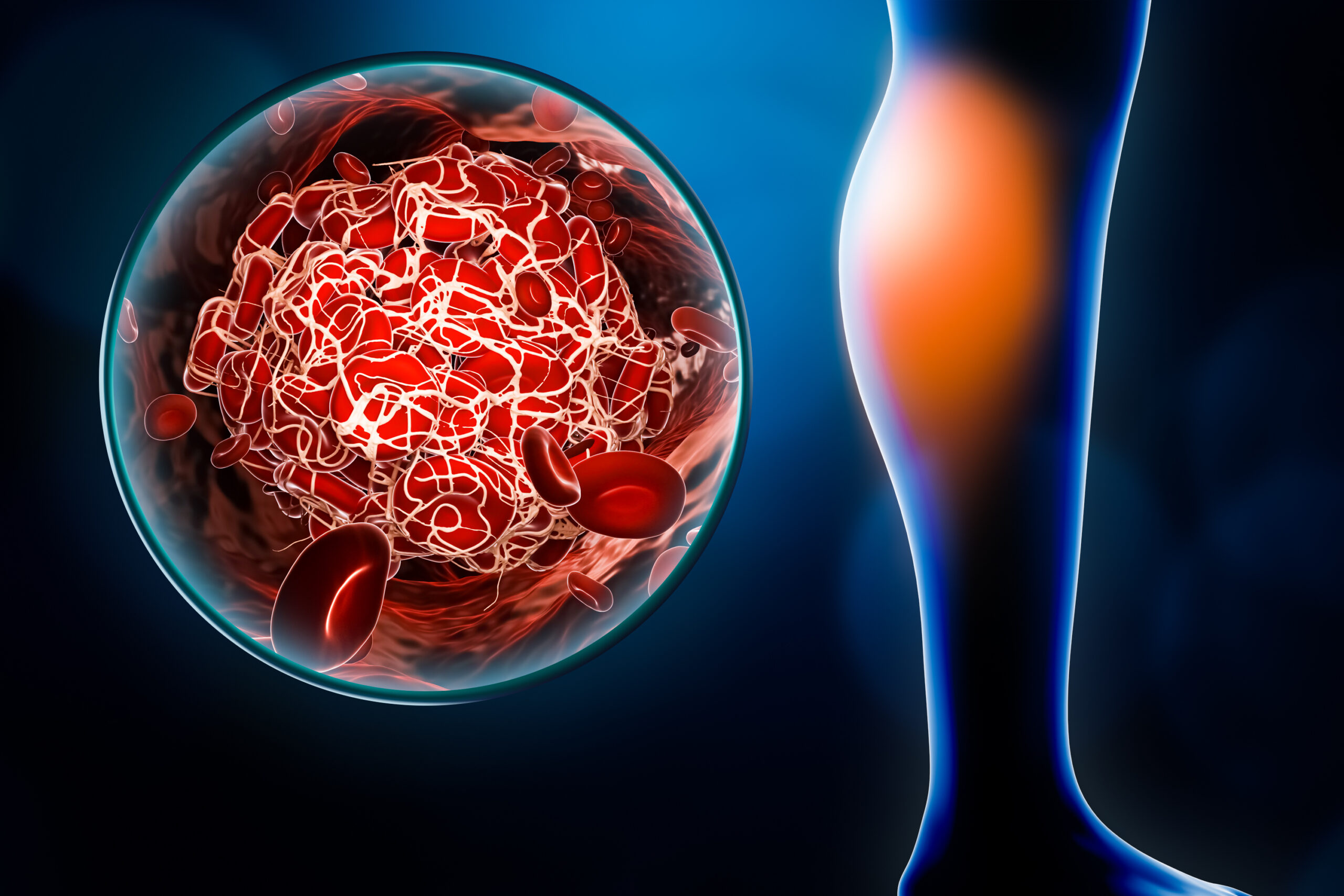 An illustration of a blood clot forming and causing pain in the lower extremities.