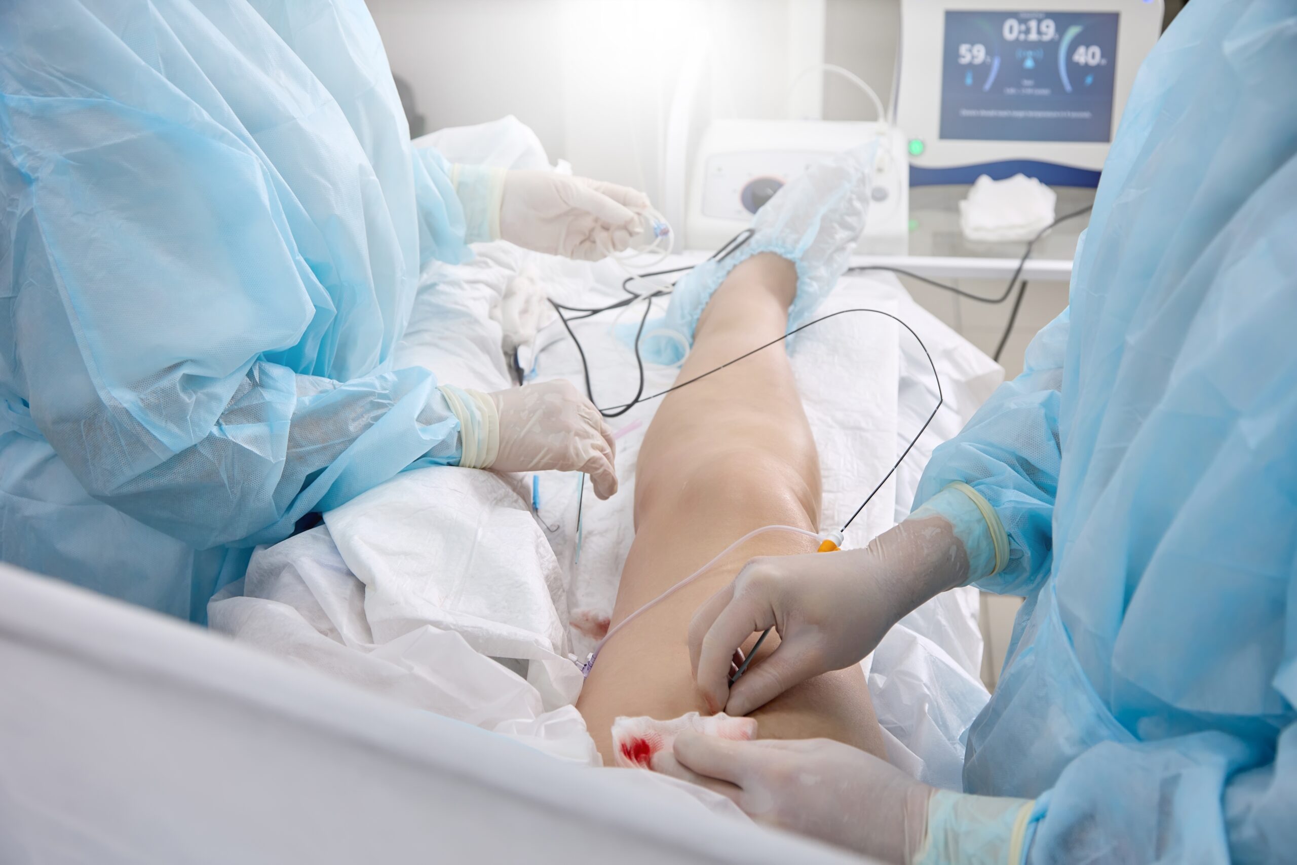 A patient receiving vein ablation treatment in an operating room with doctors.