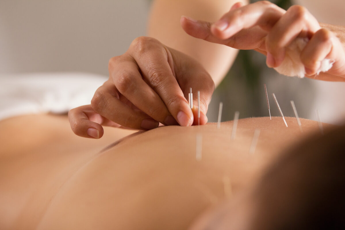 A close-up of someone receiving acupuncture for back pain.