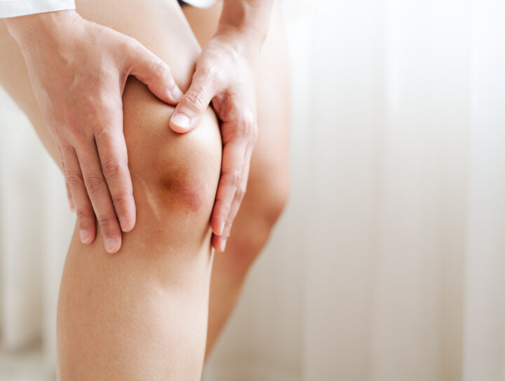 A close-up of someone holding their bruised knee that may require swollen knee treatment.
