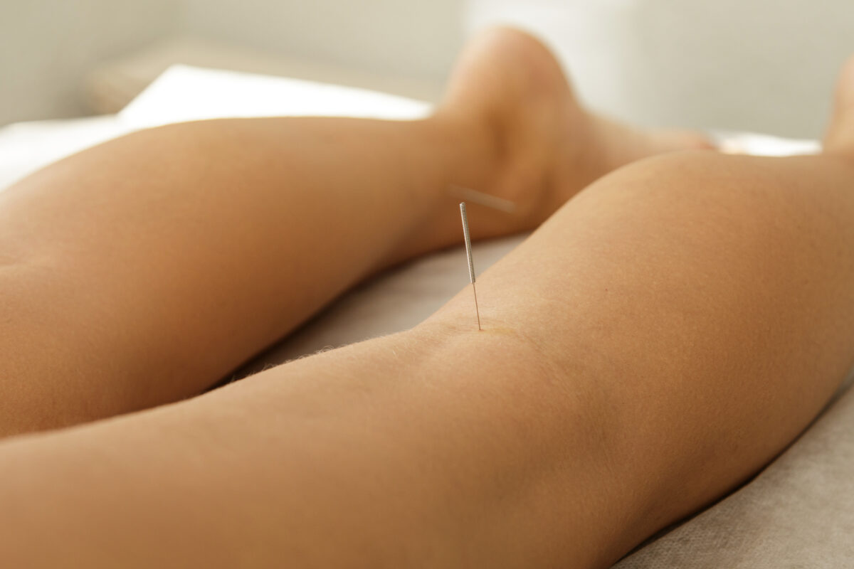 Close-up of an adult female receiving acupuncture treatment for leg pain after running.