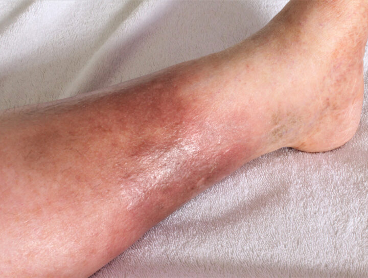 A close-up of the potential results of untreated heaviness in legs, an elderly man's lower leg bruised and swollen.