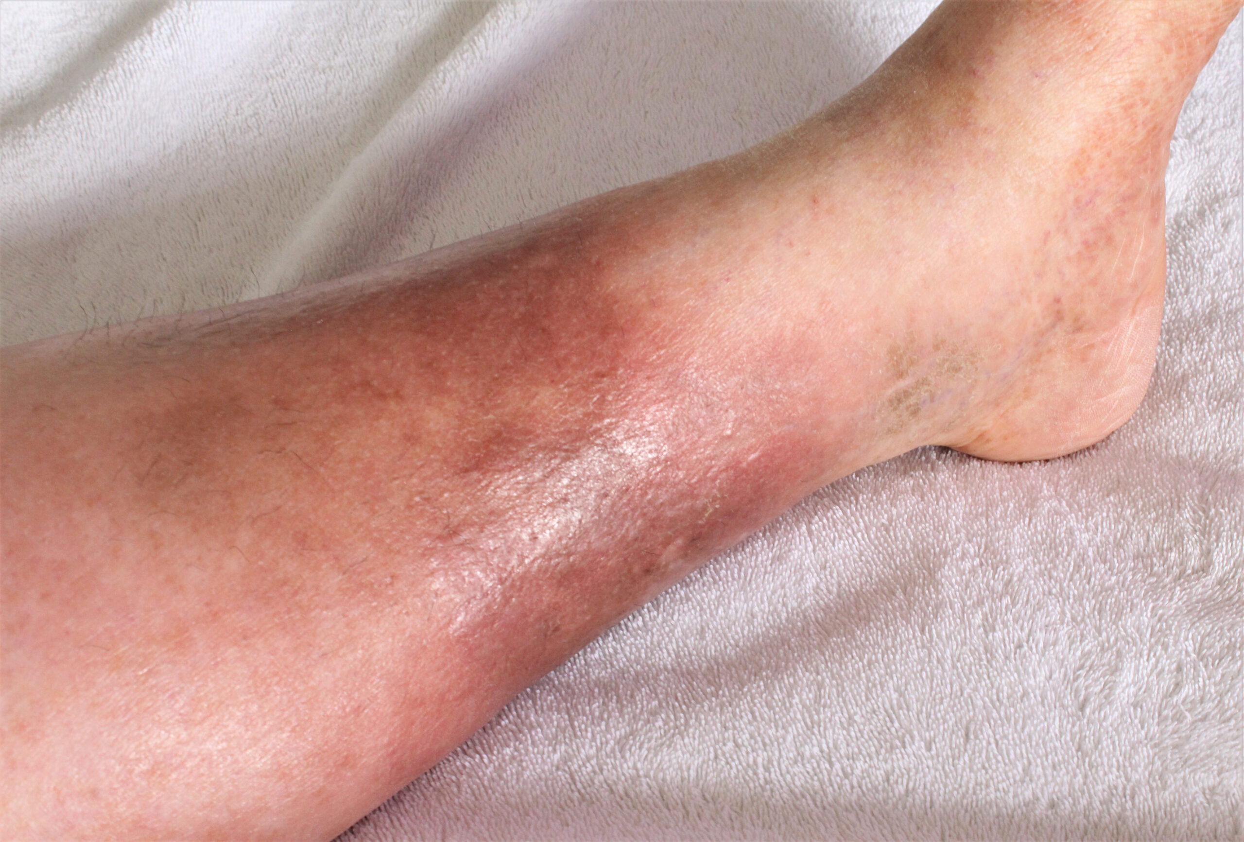A close-up of the potential results of untreated heaviness in legs, an elderly man's lower leg bruised and swollen.