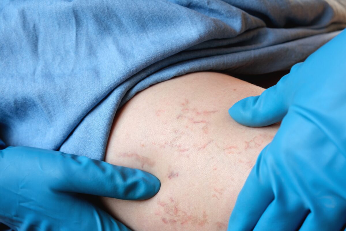 A vein doctor uses his hands to examine a patient's varicose veins.