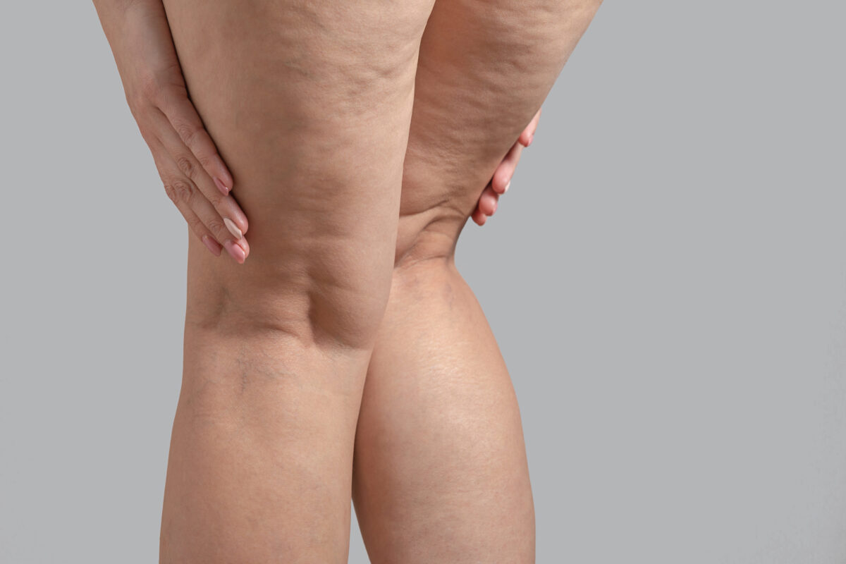 Pain in back of thigh problems cause discomfort and are symptomatic of bigger underlying vein issues, as seen in this image of the back of a lady's thighs.