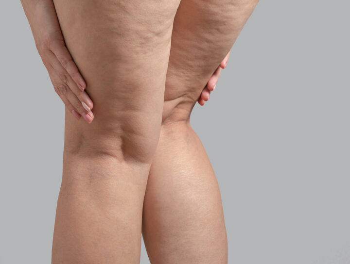 Pain in back of thigh problems cause discomfort and are symptomatic of bigger underlying vein issues, as seen in this image of the back of a lady's thighs.