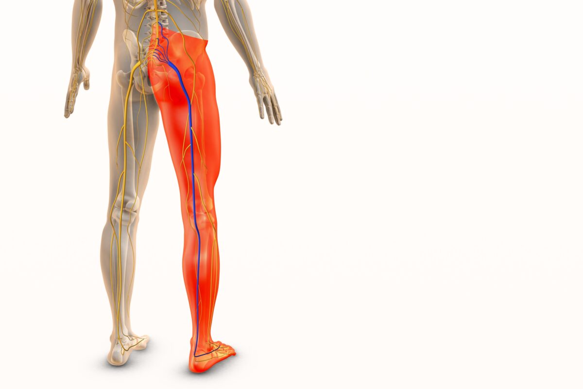 Sciatica and lower leg pain, as illustrated by the inflamed nerves running down the back of an adult male leg in this medical diagram, should cause patients to understand what's behind it.