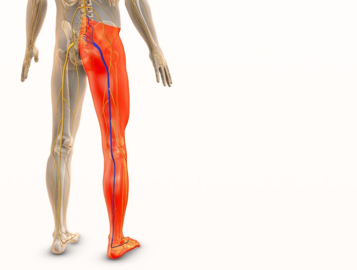 Sciatica and lower leg pain, as illustrated by the inflamed nerves running down the back of an adult male leg in this medical diagram, should cause patients to understand what's behind it.