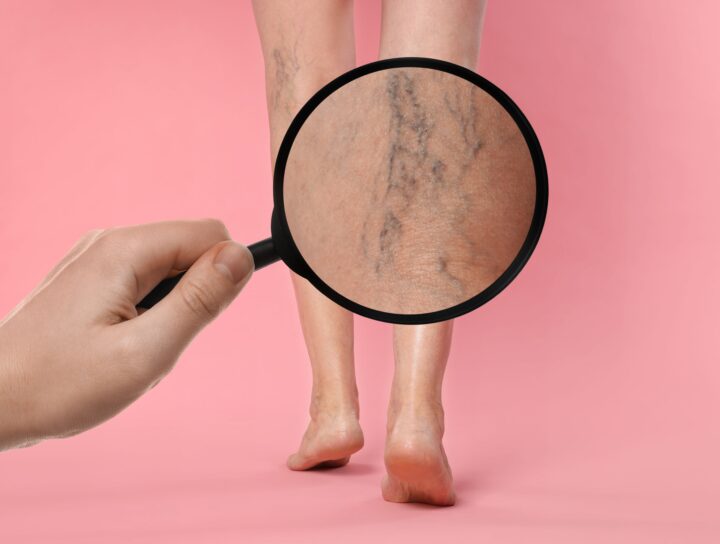 A magnifying glass zooms-in on unhealthy veins on a pair of legs, illustrating the best treatment for large varicose veins.