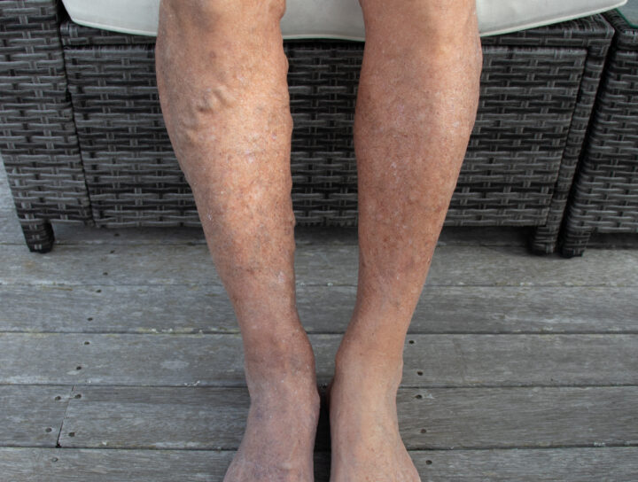 Circulation issues in legs is a major health problem with many adults, as evidenced by this man's varicose vein and spider vein legs.
