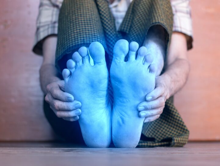An image of itchy, blue feet that feel on fire for a patient who has poor circulation to feet problems.