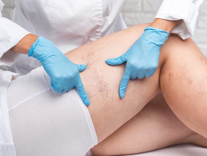 Finding the best Sclerotherapy treatment starts with talking to a pain management specialist, like this patient who is seeking solutions for her spider vein legs.