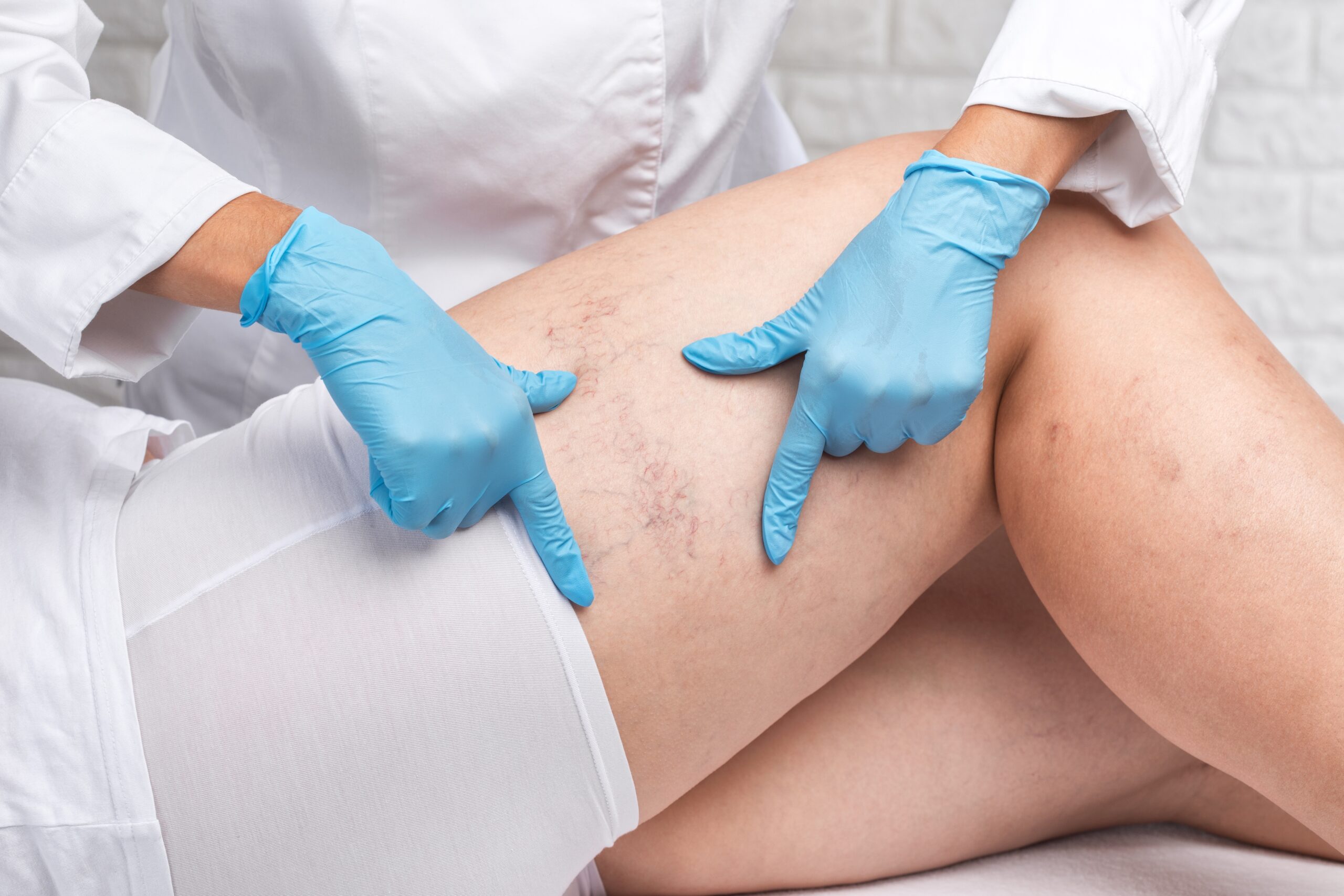 Finding the best Sclerotherapy treatment starts with talking to a pain management specialist, like this patient who is seeking solutions for her spider vein legs.