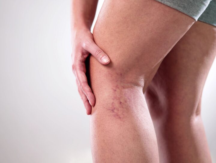 A lady gripping her spider vein legs, feeling pain, and in need of a blood circulation doctor specialist.