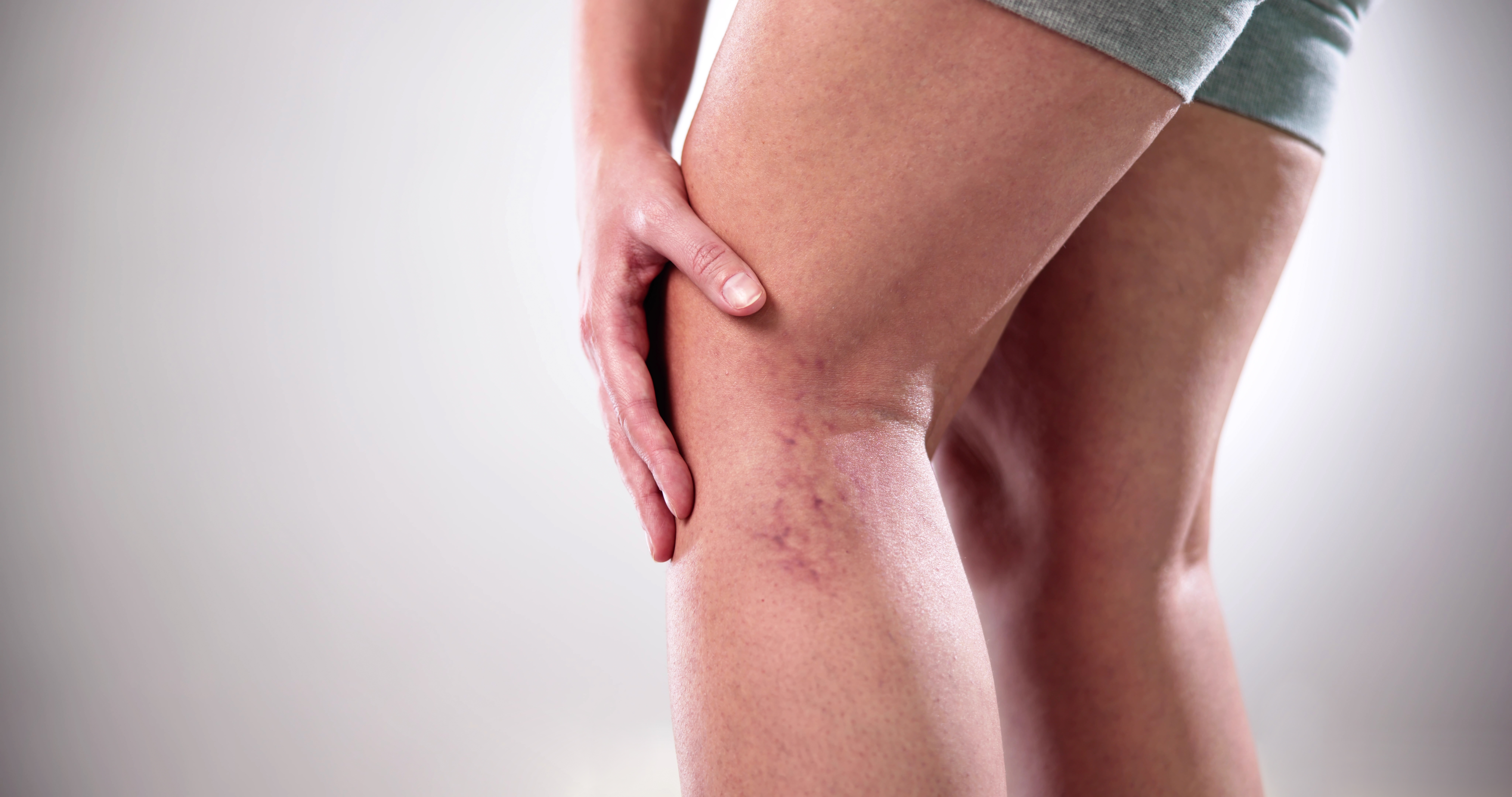 A lady gripping her spider vein legs, feeling pain, and in need of a blood circulation doctor specialist.