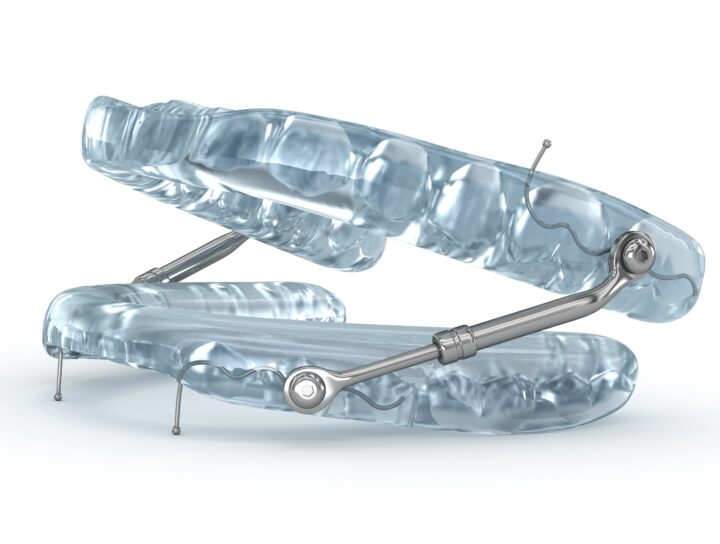 A modern sleep apnea oral device being displayed, illustrating its convenient mechanics and fit for nearly any mouth.