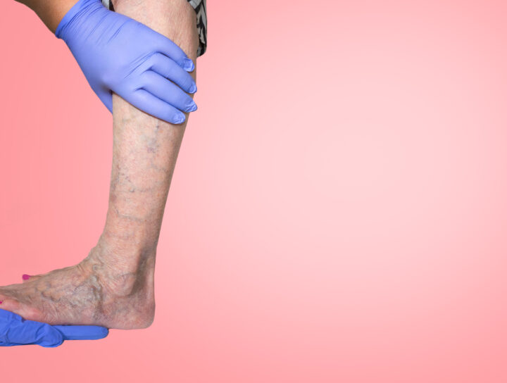 This woman patient's leg needs varicose vein removal treatment, as evidenced by the pain management specialist doctor who is diagnosing her problem with his hands.