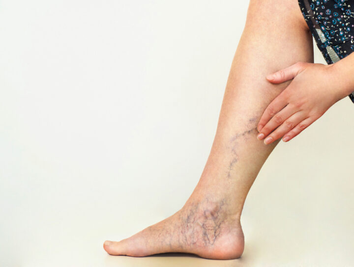 A middle-age woman feels her painful varicose veins on her leg as she considers lasering spider veins.