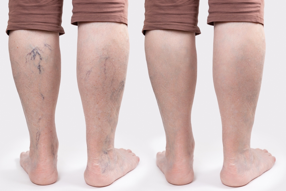Varicosity,And,Thrombosis.,Close,Up,Of,Elderly,Feet,Of,Woman