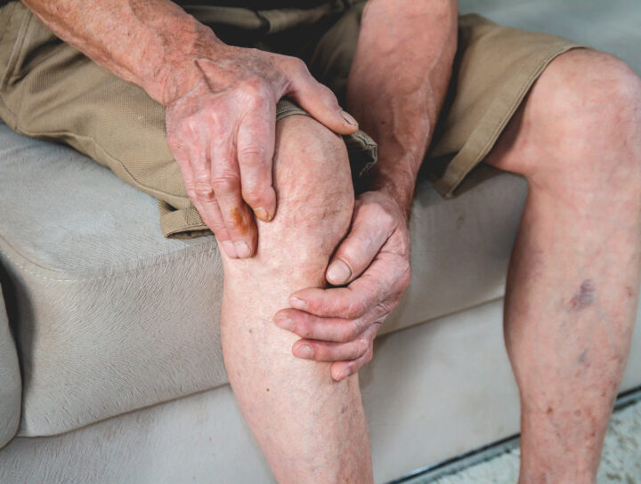 Spider vein removal is directly connected to the aging process for many adults with achy, burning, and itchy lower extremities.