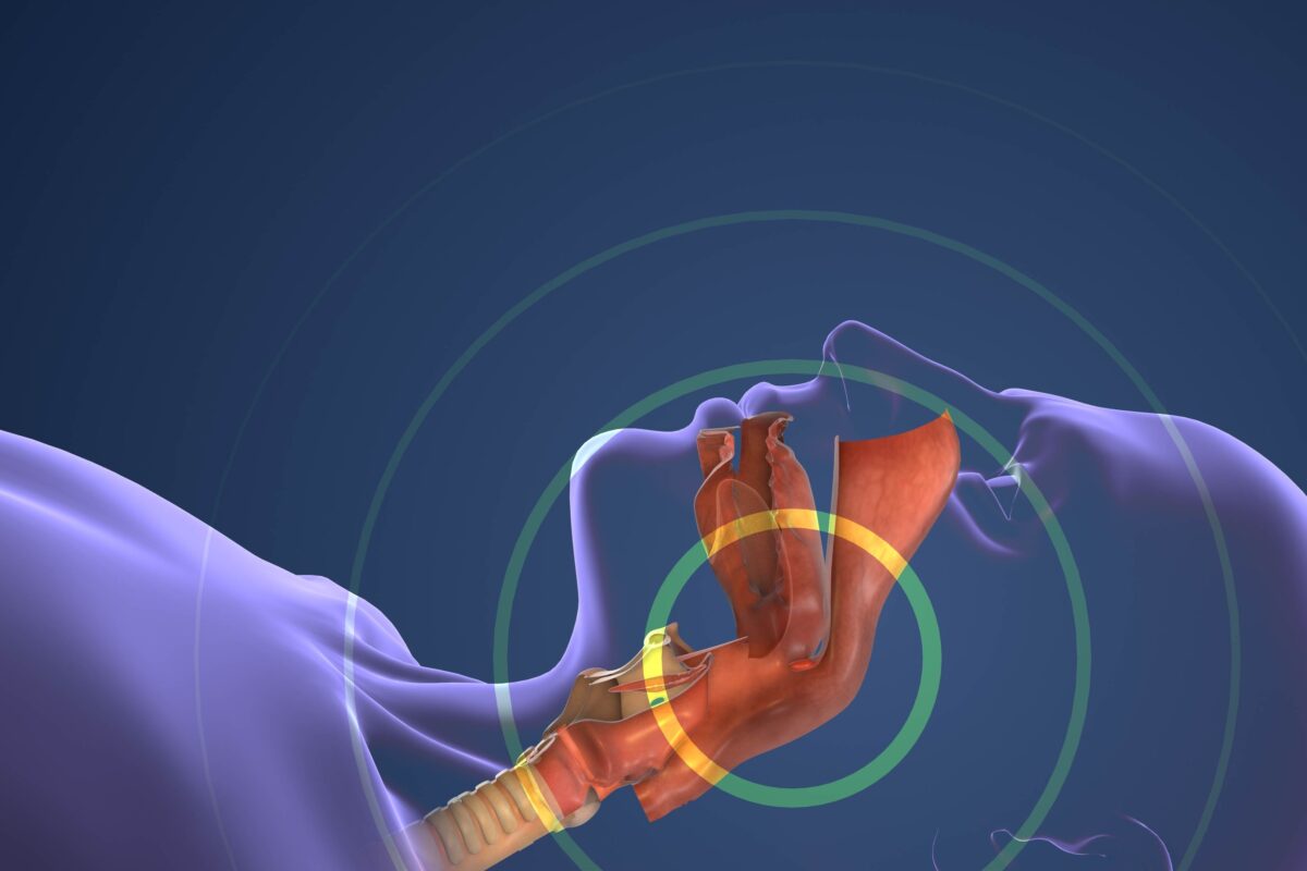 Oral appliance for sleep apnea trends and results show that mouthpieces are a successful option for many sleep apnea patients.