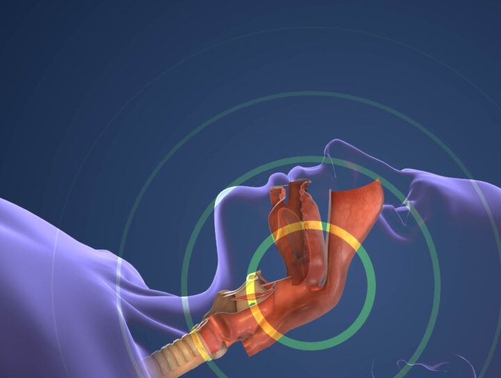 Oral appliance for sleep apnea trends and results show that mouthpieces are a successful option for many sleep apnea patients.