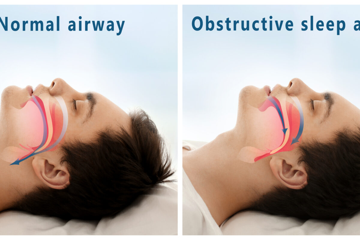 A sleep apnea oral appliance can help this male adult patient who is sleeping and disturbed by Obstructive Sleep Apnea as he lays on his bed and snores on his pillow.