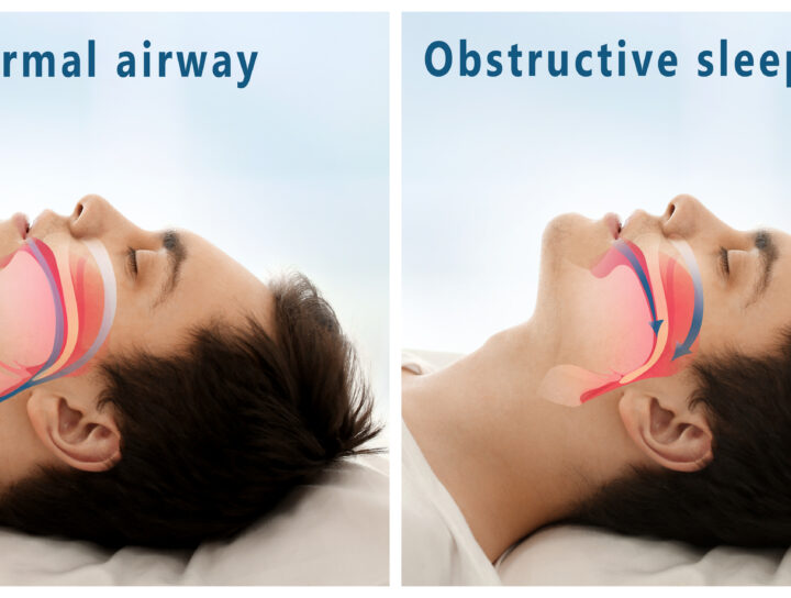 A sleep apnea oral appliance can help this male adult patient who is sleeping and disturbed by Obstructive Sleep Apnea as he lays on his bed and snores on his pillow.