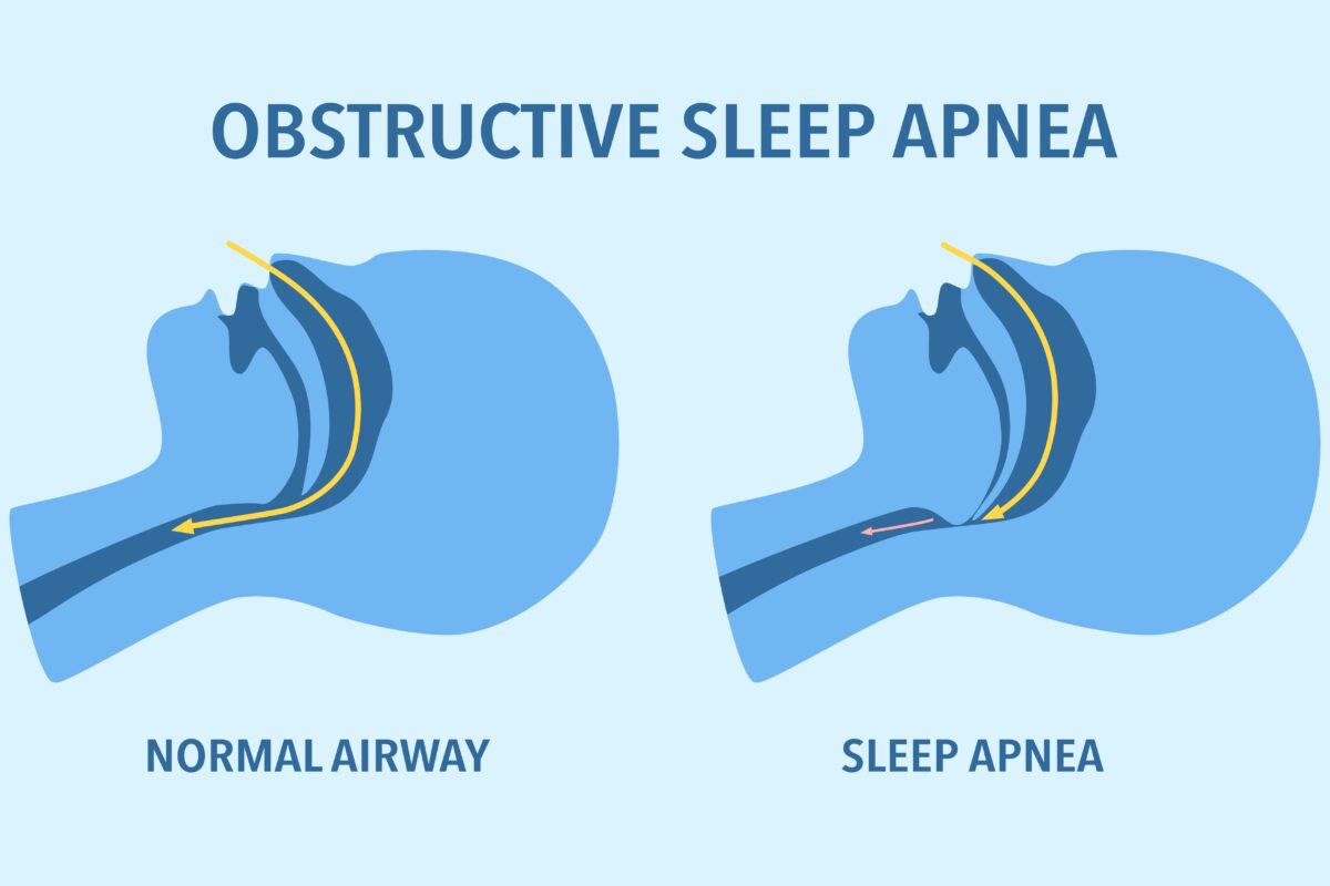 As illustrated by this Obstructive Sleep Apnea diagram that shows a human's airways, hearing directly from adults who live with apnea as you treat sleep apnea can offer invaluable insights.