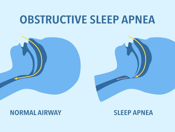 As illustrated by this Obstructive Sleep Apnea diagram that shows a human's airways, hearing directly from adults who live with apnea as you treat sleep apnea can offer invaluable insights.