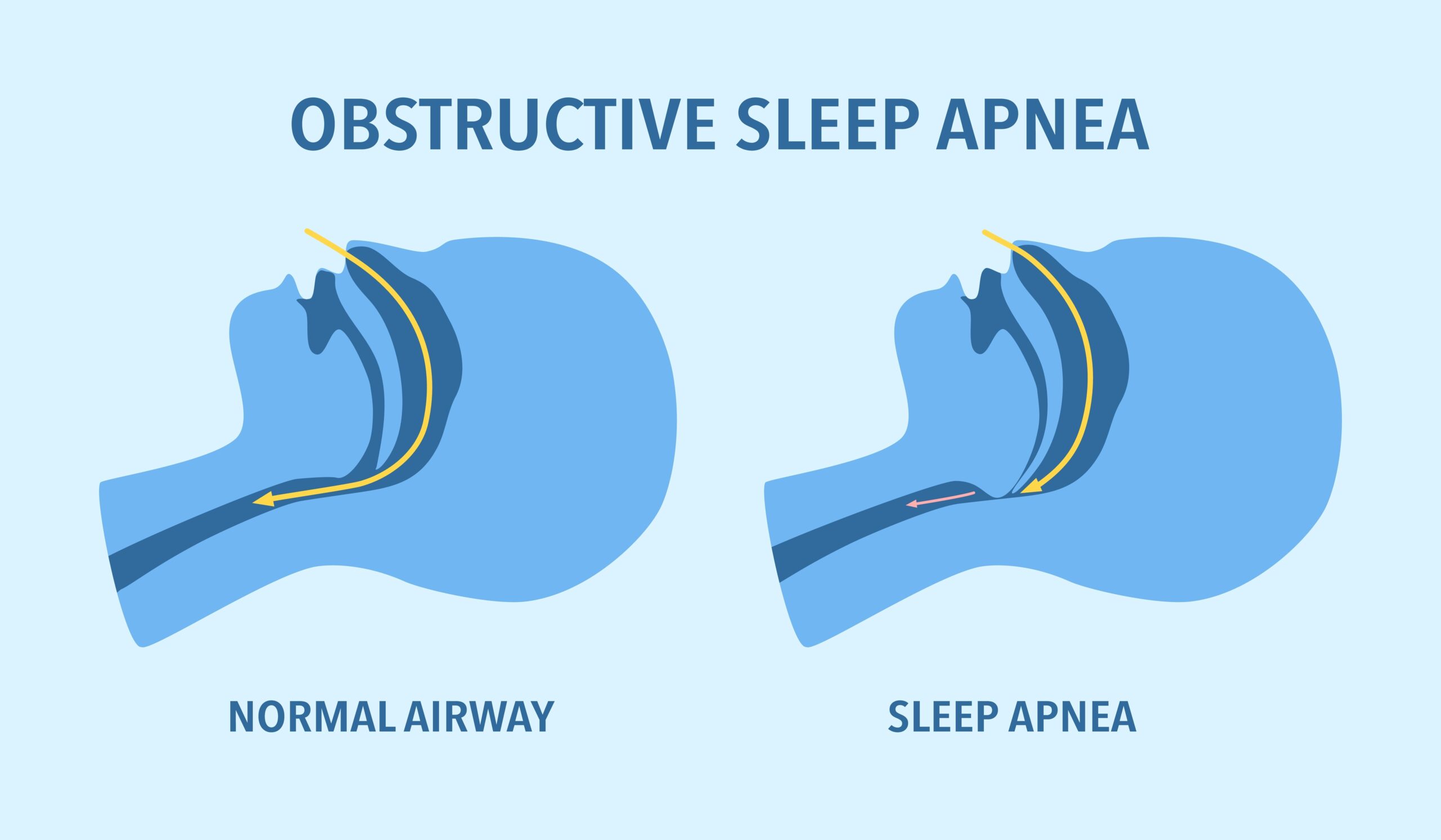 As illustrated by this Obstructive Sleep Apnea diagram that shows a human's airways, hearing directly from adults who live with apnea as you treat sleep apnea can offer invaluable insights.