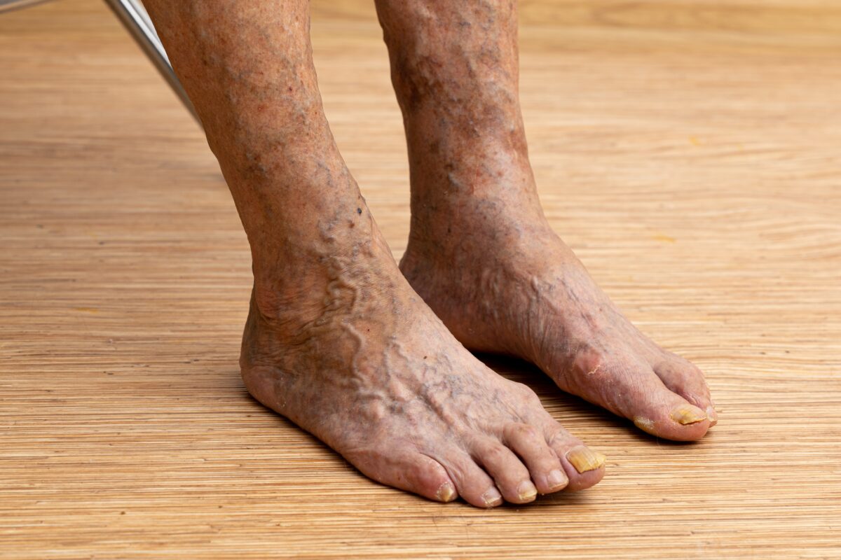 These are detrimental spider veins on this man's feet; and while they’re usually harmless, they can feel frustrating when you’re trying to look your best.