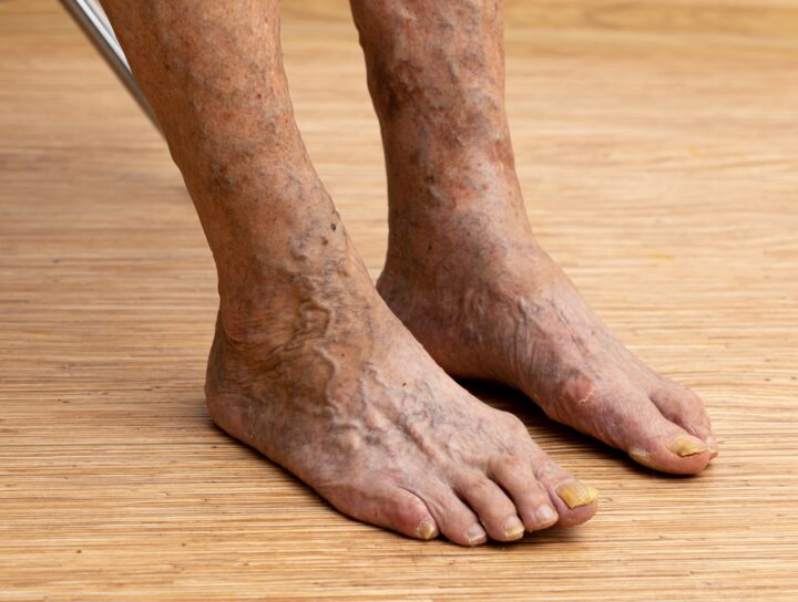 These are detrimental spider veins on this man's feet; and while they’re usually harmless, they can feel frustrating when you’re trying to look your best.
