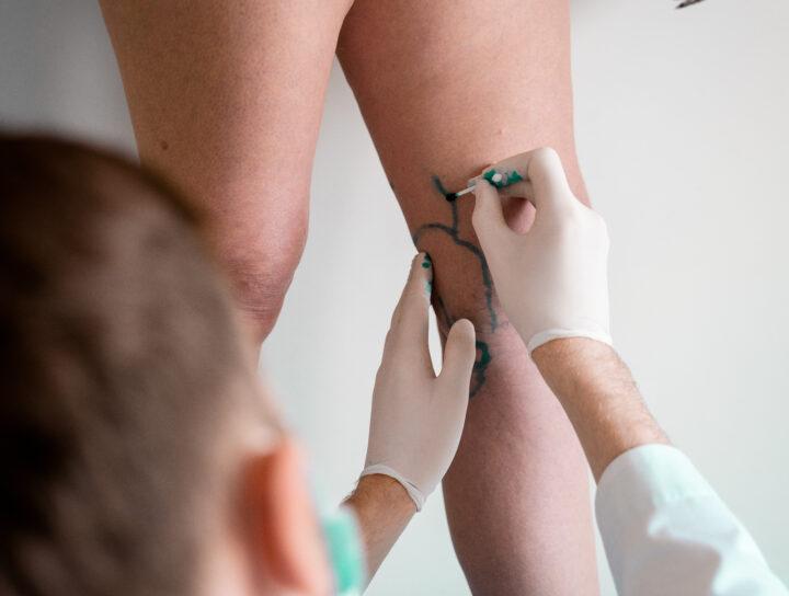 A woman patient who is seeking spider vein treatment, with her legs being marked up by a venous specialist doctor using a special pen.