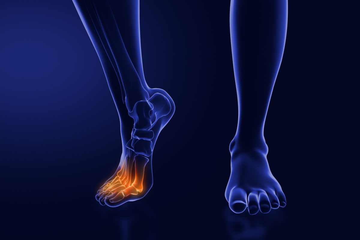 Treatment for neuropathy in legs and feet is illustrated by this x-ray graphical illustration of pain radiating through a human's foot.