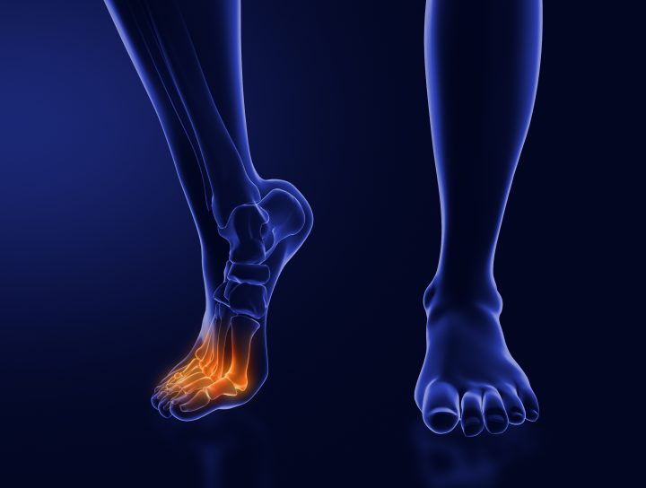 Treatment for neuropathy in legs and feet is illustrated by this x-ray graphical illustration of pain radiating through a human's foot.