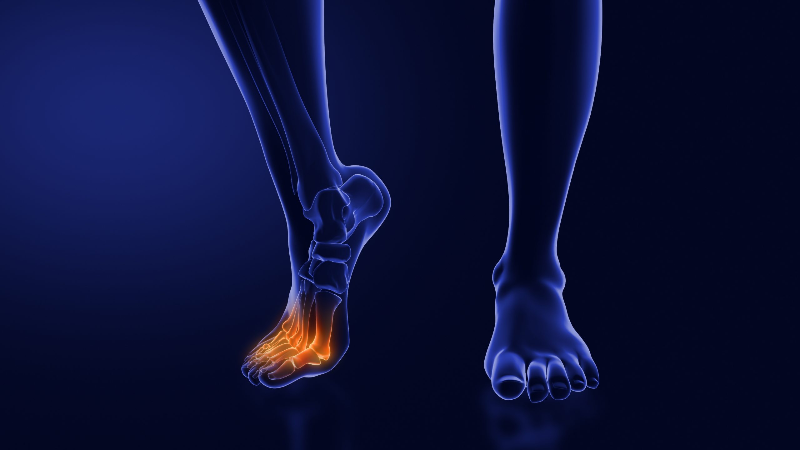 Treatment for neuropathy in legs and feet is illustrated by this x-ray graphical illustration of pain radiating through a human's foot.