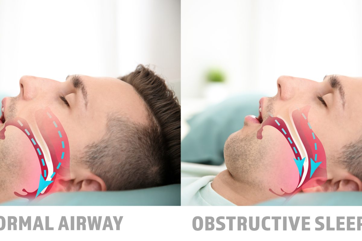 A custom sleep apnea device helps patients get back to normal sleep, as illustrated by this dual-image photo of the same man sleeping with a normal airway on the left versus his discomfort from Obstructive Sleep Apnea on the right.