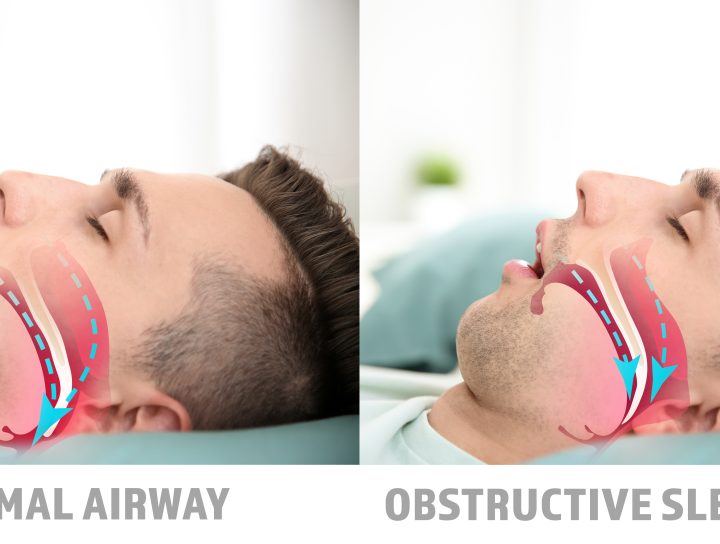 A custom sleep apnea device helps patients get back to normal sleep, as illustrated by this dual-image photo of the same man sleeping with a normal airway on the left versus his discomfort from Obstructive Sleep Apnea on the right.