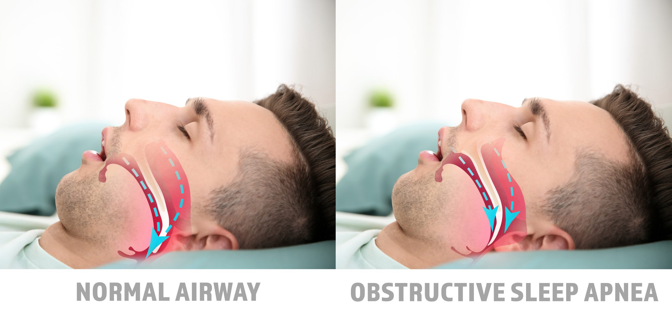 A custom sleep apnea device helps patients get back to normal sleep, as illustrated by this dual-image photo of the same man sleeping with a normal airway on the left versus his discomfort from Obstructive Sleep Apnea on the right.