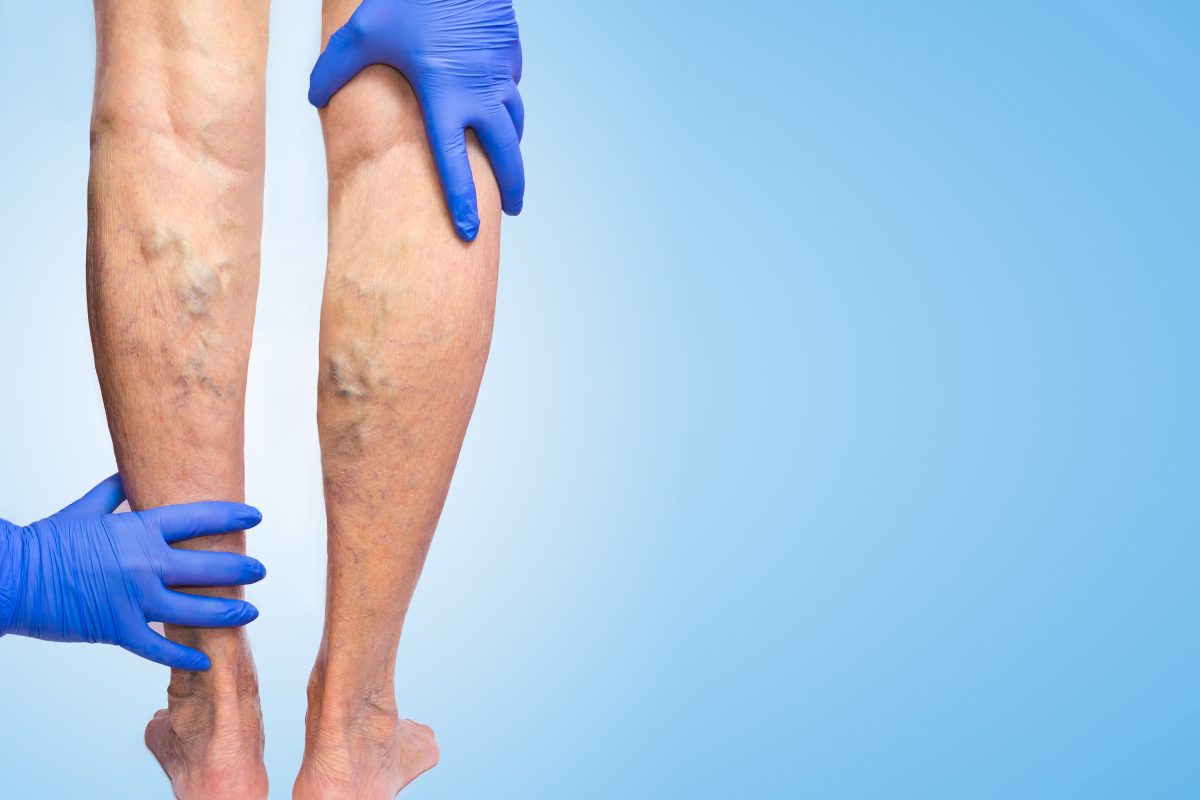 Venous insufficiency, like this poor patient's swollen varicose veins as a doctor inspects them, is a condition that should be looked at immediately.