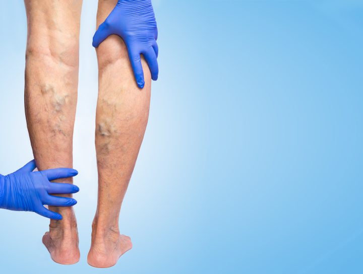 Venous insufficiency, like this poor patient's swollen varicose veins as a doctor inspects them, is a condition that should be looked at immediately.